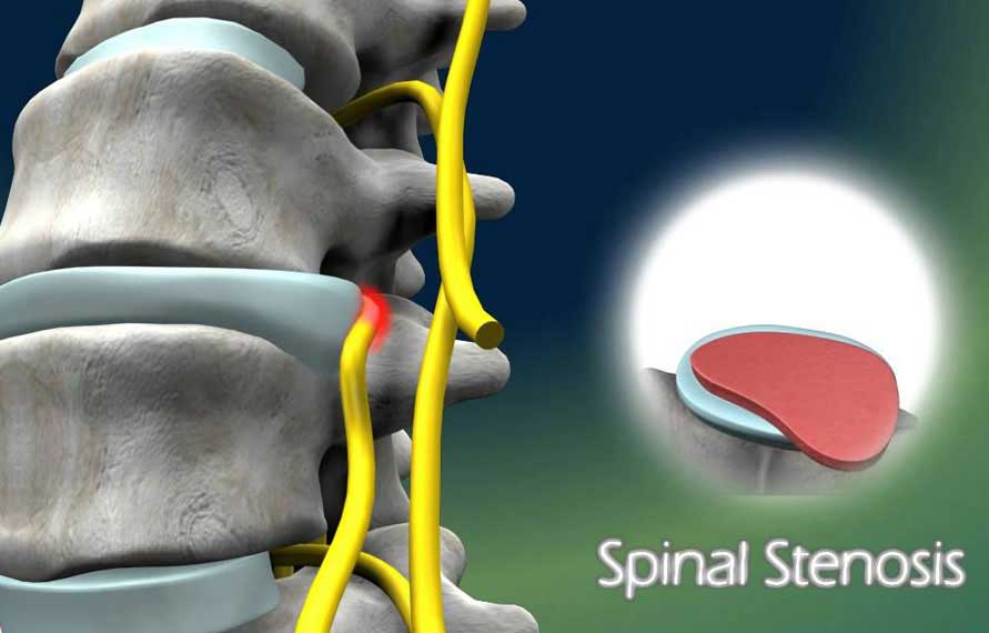 Neuro and Spine Surgery Packages in India